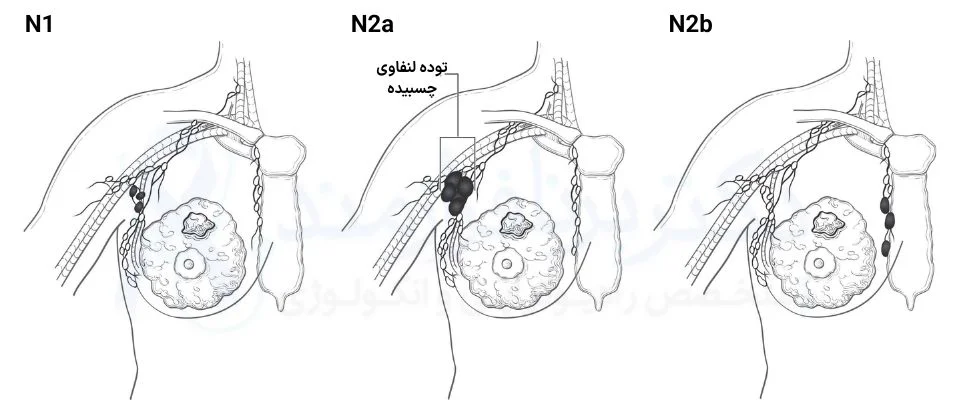مرحله لنفاوی سرطان سینه، طبقه N1 و N2