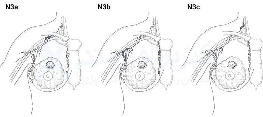مرحله بندی سرطان سینه، طبقه لنف نود، طبقه N3
