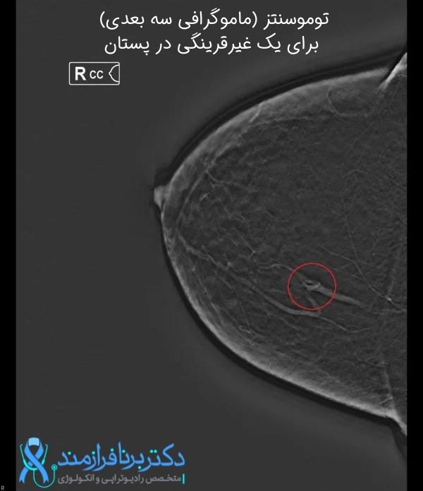 توموسنتز دیجیتال پستان (مامو گرافی سه بعدی) برای یک غیر قرینگی در پستان