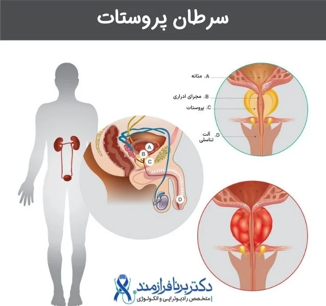 سرطان پروستات چیست، کانسر پروستات، ارتباط پروستات و مثانه و بیضه
