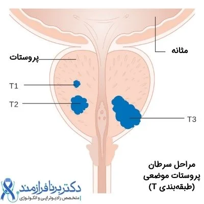 مراحل سرطان پروستات (طبقه بندی T)