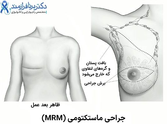 جراحی سرطان سینه از نوع ماستکتومی