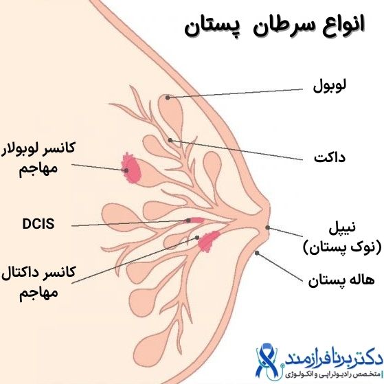 انواع سرطان پستان