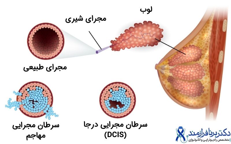 سرطان مجرایی (داکتال) تهامی و سرطان داکتال درجا (DCIS)