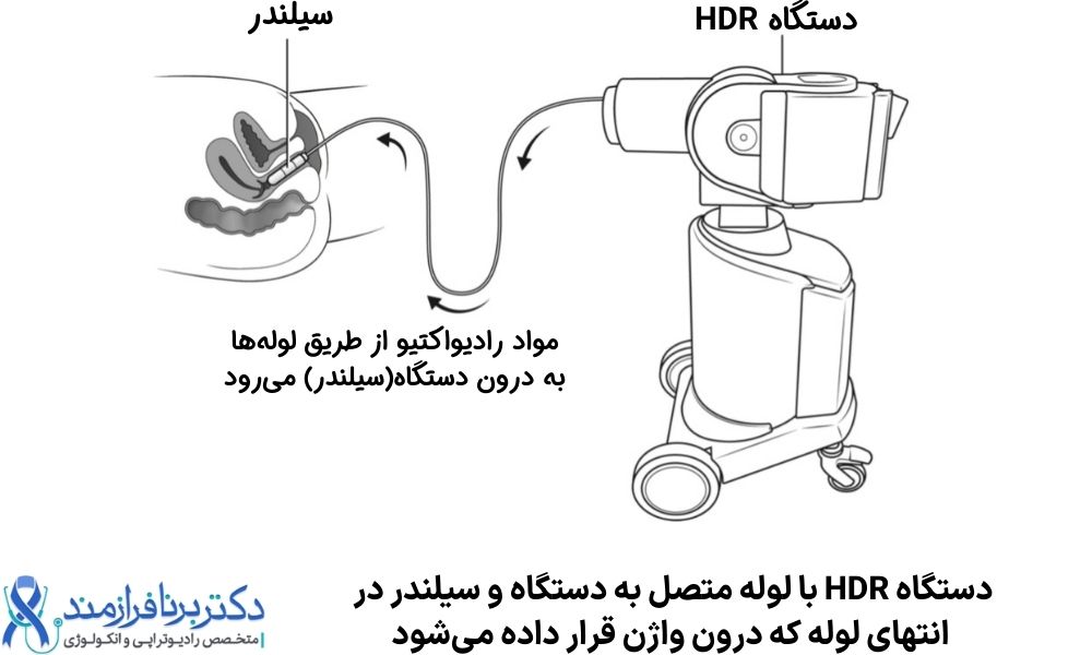 دستگاه HDR براکی تراپی و پرتو درمانی داخلی واژن برای سرطان رحم