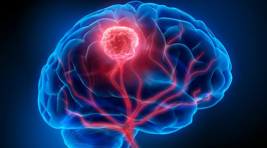 تومور مغزی چیست، سرطان مغز