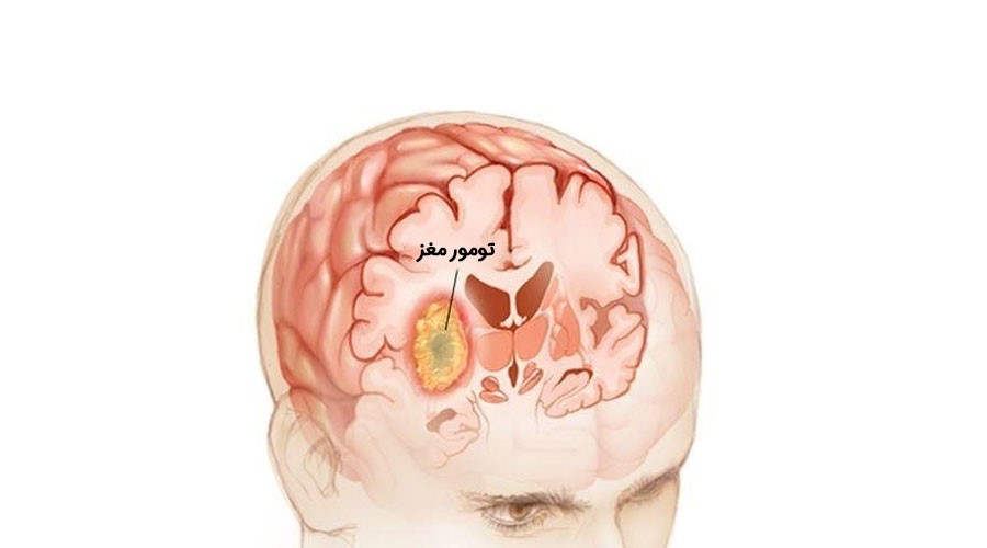 درمان تومور مغزی با ایمونوتراپی