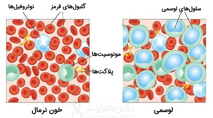 تفاوت سرطان خون (لوکمی یا لوسمی) با خون طبیعی