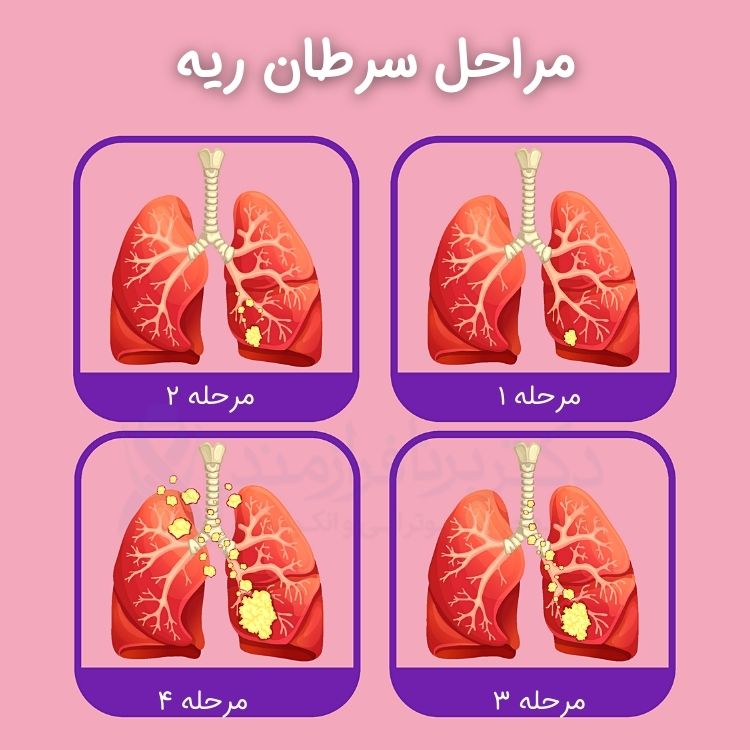مراحل سرطان ریه، تعیین مرحله سرطان ریه