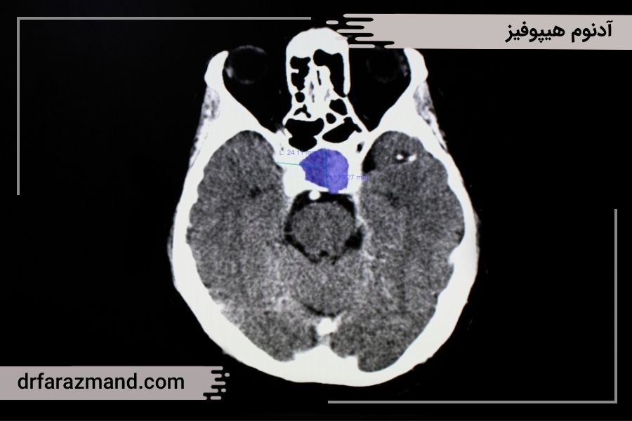 آدنوم هیپوفیز، یکی از انواع تومور مغزی خوش خیم
