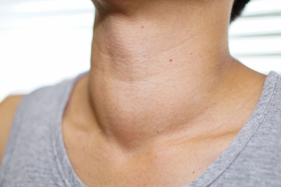 تورم و برجستگی گردن، یکی از علائم سرطان تیروئید