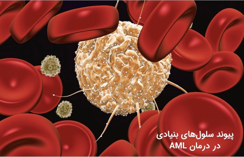 پیوند سلول‌های بنیادی در AML، درمان سرطان خون نوع AML