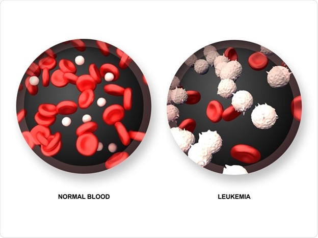 خون طبیعی در مقایسه با لوکمی