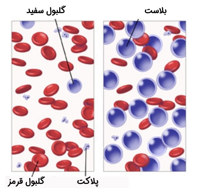 سلول های بلاست در سرطان خون