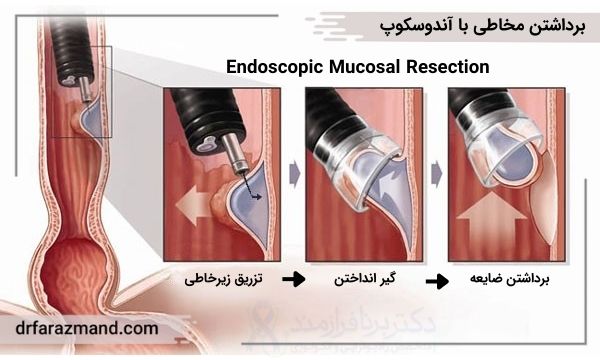 برداشتن مخاطی با آندوسکوپ، endoscopic mucosal resection یا EMR