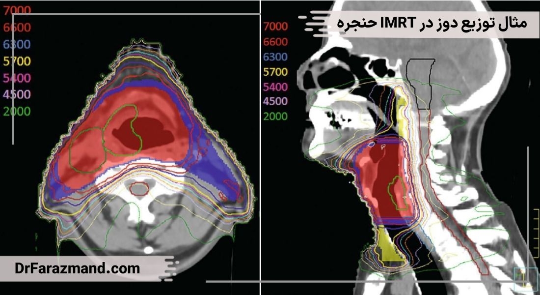 توزیع دوز IMRT، رادیوتراپی کانسر لارنکس، پرتو درمانی سرطان حنجره