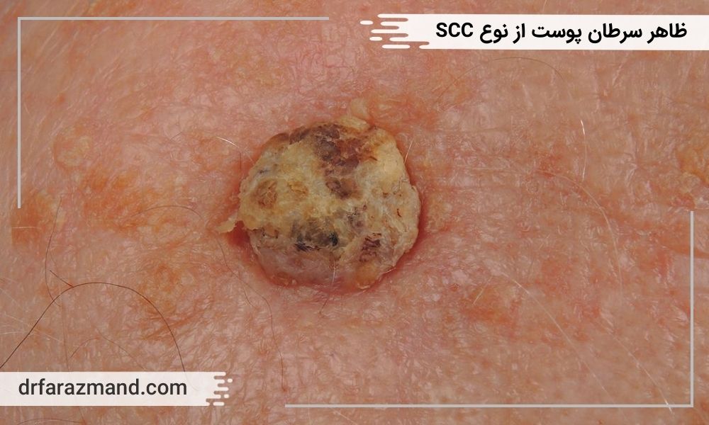 ظاهر سرطان پوست از نوع SCC، عکس سرطان پوست، اسکواموس پوست
