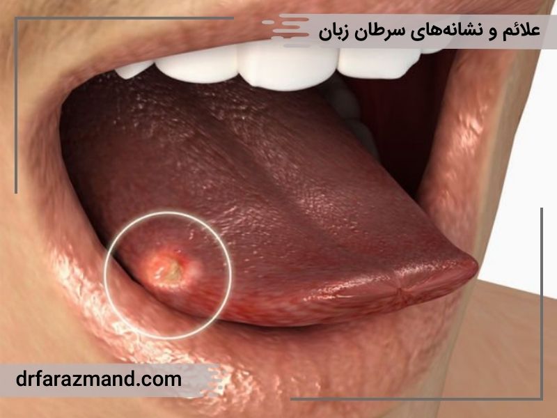 نشانه ها و علائم سرطان زبان