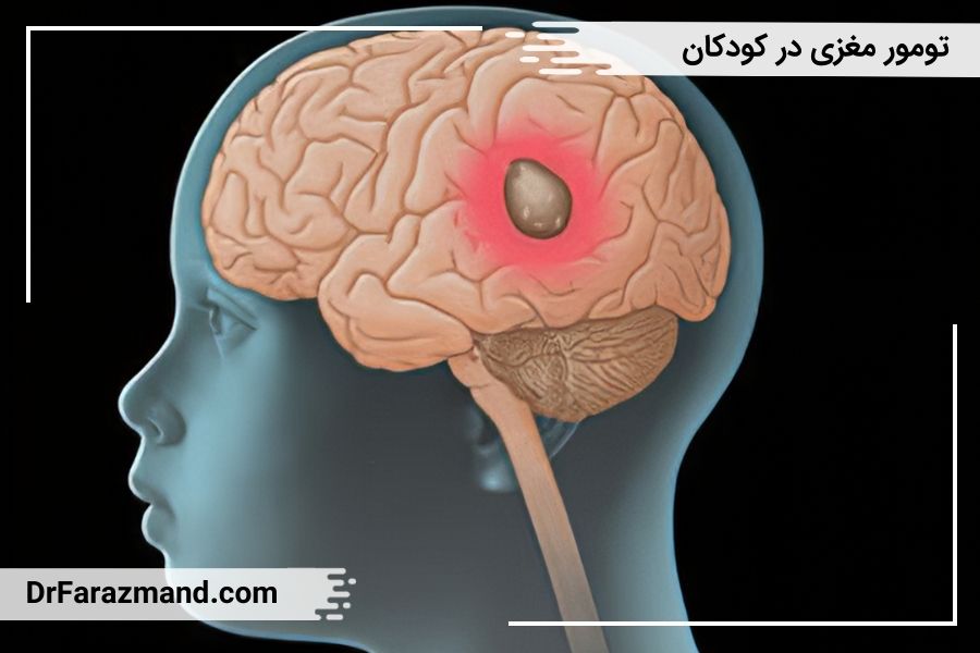 تومور مغزی کودکان، تومور در سر اطفال