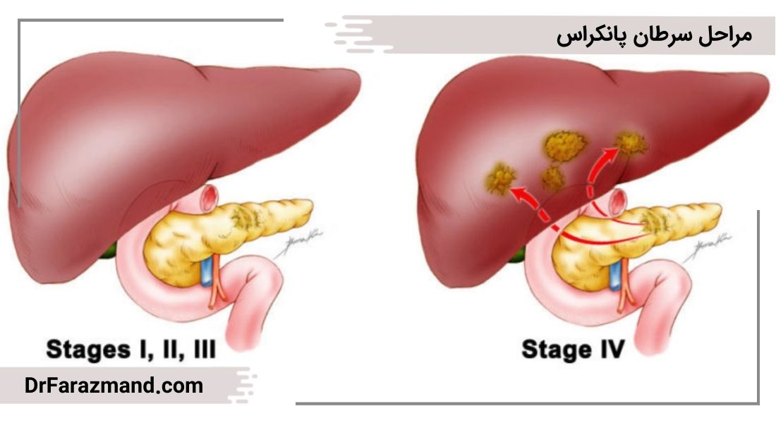 مرحله بندی سرطان پانکراس، کانسر لوزالمعده مرحله ۴