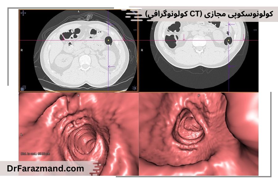 CT کولونوگرافی، کولونوسکوپی مجازی