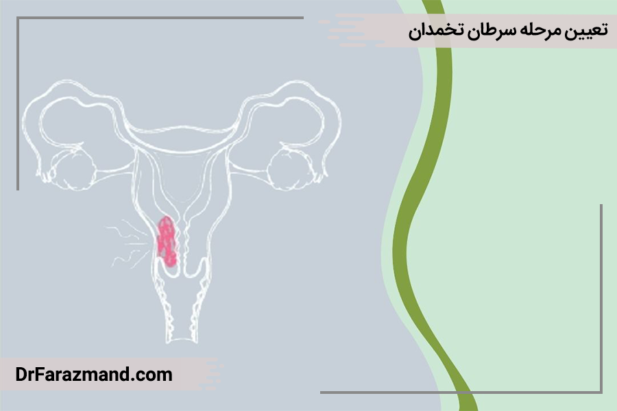 تعیین مرحله سرطان تخمدان