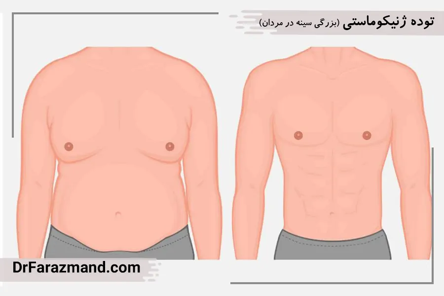 توده ژنیکوماستی