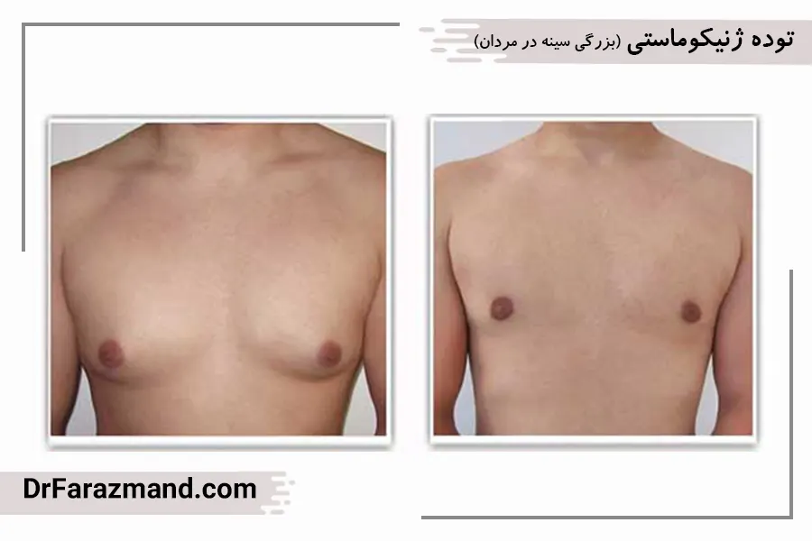 توده ژنیکوماستی قبل و بعد
