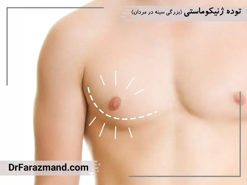 توده ژنیکوماستی