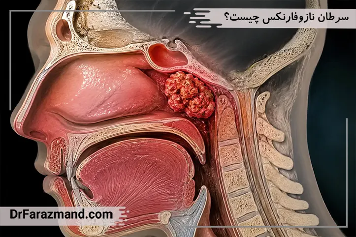 سرطان نازوفارنکس چیست؟