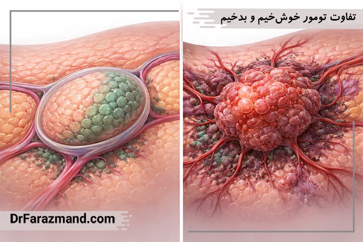 تفاوت تومور خوش‌خیم و بدخیم