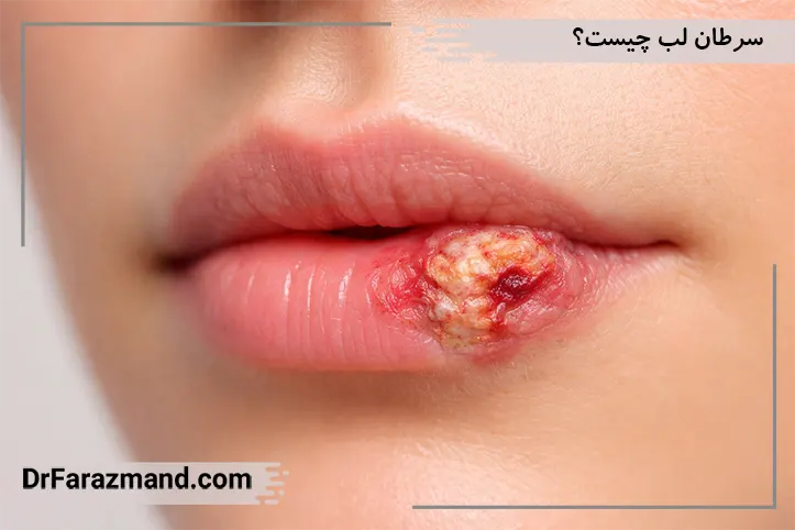 سرطان لب چیست